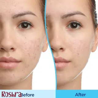 ژل ضد جوش دیفرین  image